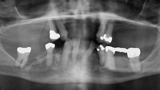 X-ray of damaged and repaired smile