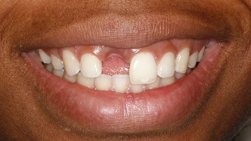 Missing front tooth