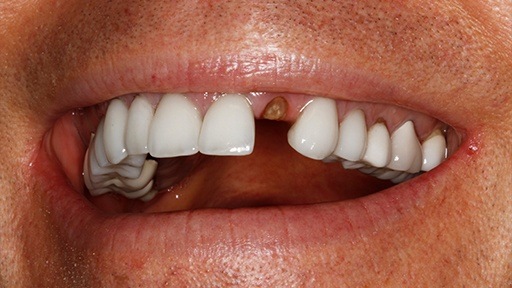 Closeup of smile with missing tooth
