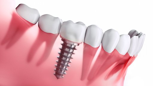 diagram of dental implants in Millersville 