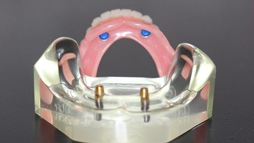 Model of implant supported denture