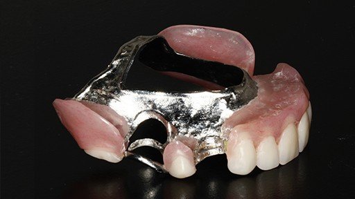 Partial denture prior to placement