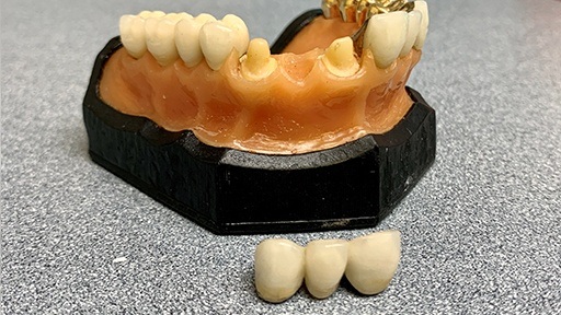 Model smile and fixed bridge restoration