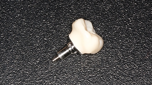 Implant supported dental crown