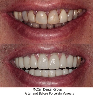 Before and after image of real patient with porcelain veneers