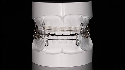 Sleep apnea oral appliance