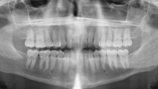 Panoramic dental x-rays