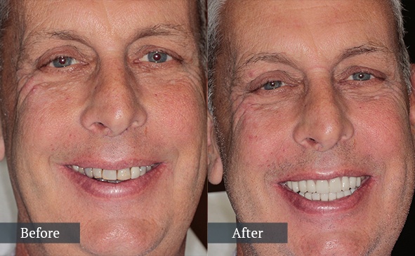 Before and after image of real patient with porcelain veneers