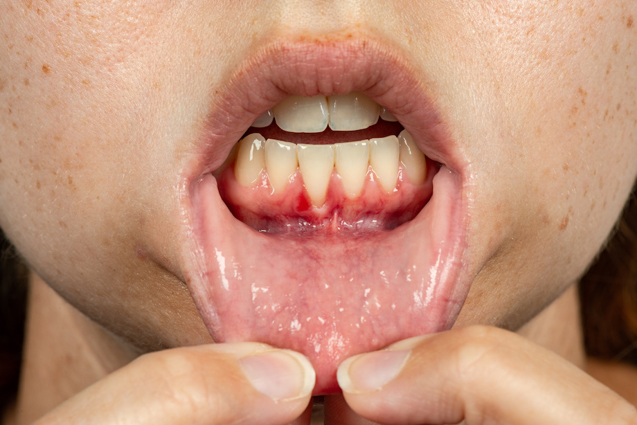 Close up of gum recession on lower teeth